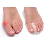 Uriel - Teenspreider - Hallux valgus - Voorvoetkussen - Gel - Drukverlichting - 1 paar